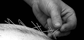 Acupuncture in Shoreham By Sea
